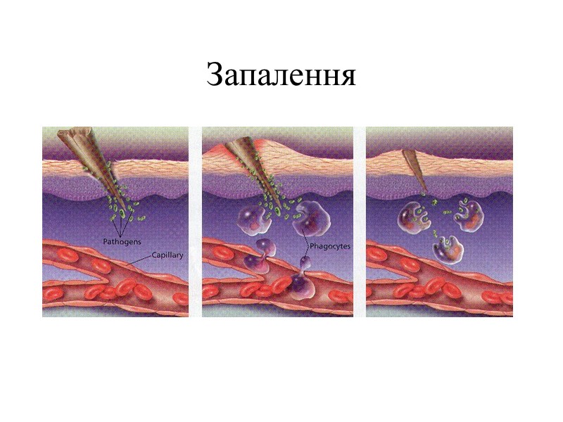 Запалення